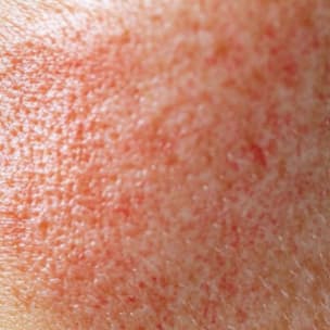 Redness skin domain texture